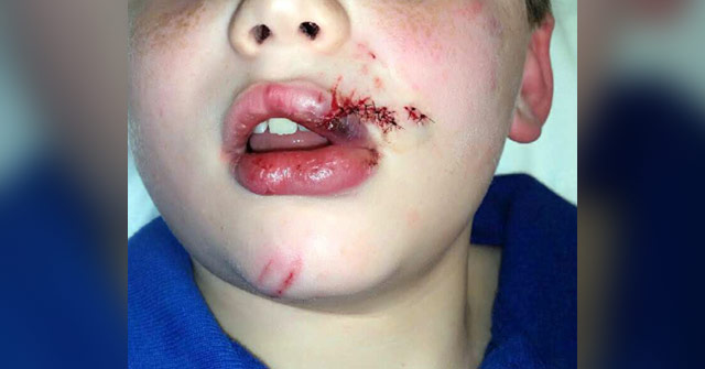 Mother Shares Story After Rescue ‘Lab-Mix’ Bites Son in the Face During Visitation with His Father